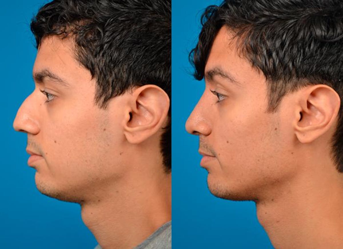 Rhinoplasty Before & After Gallery - Patient 122406796 - Image 2