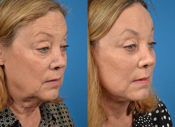 Skin Resurfacing Before & After Gallery - Patient 122406795 - Image 2