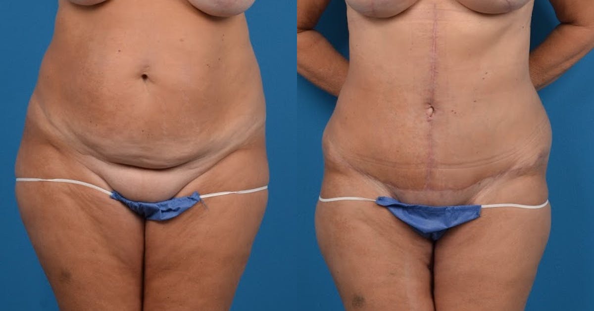 Hidden Tummy Tuck Before & After Gallery - Patient 725304 - Image 1