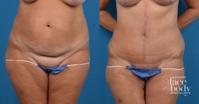 Hidden Tummy Tuck Before & After Gallery - Patient 725304 - Image 1