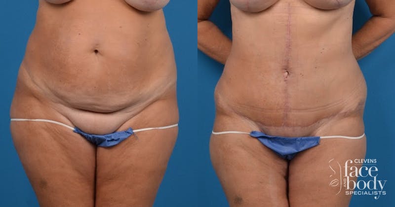 Hidden Tummy Tuck Before & After Gallery - Patient 725304 - Image 1