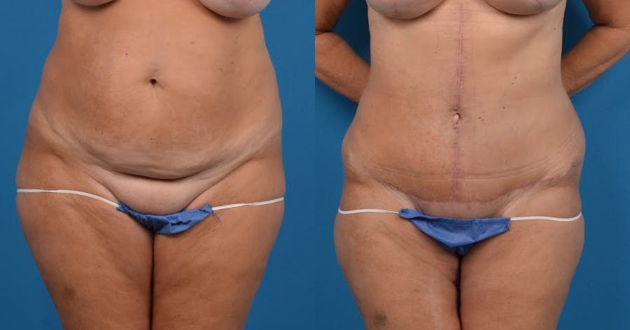 Tummy Tuck Before & After Gallery - Patient 122406797 - Image 1