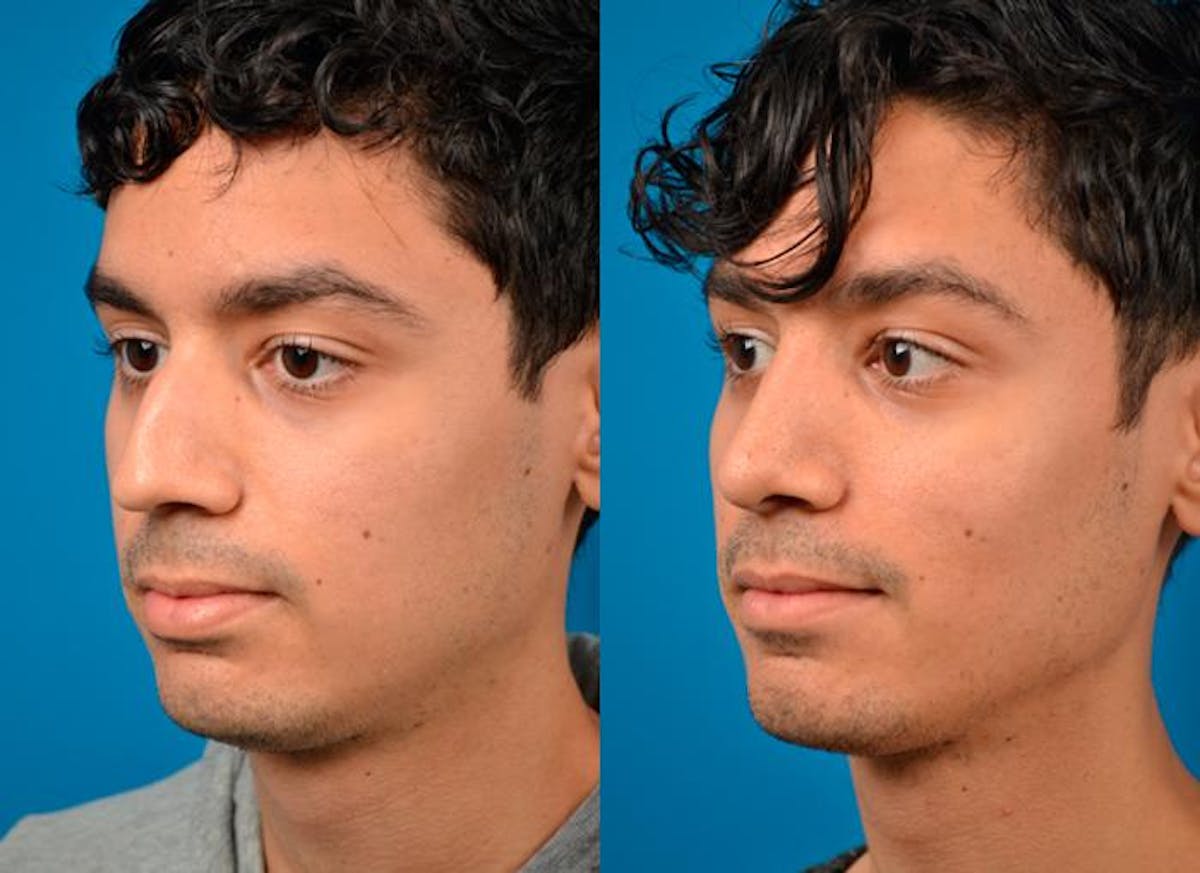 Rhinoplasty Before & After Gallery - Patient 122406796 - Image 3