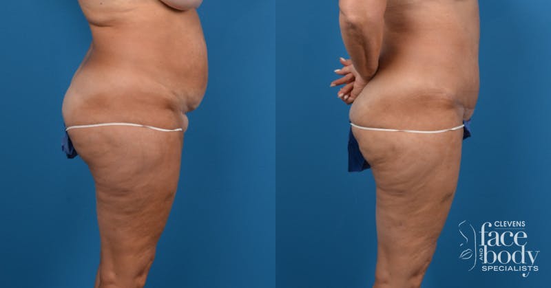 Hidden Tummy Tuck Before & After Gallery - Patient 725304 - Image 2