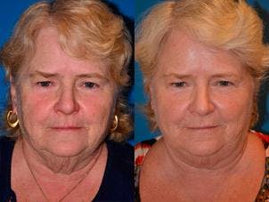 Skin Resurfacing Before & After Gallery - Patient 122406798 - Image 1