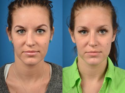 Rhinoplasty Before & After Gallery - Patient 122406799 - Image 1
