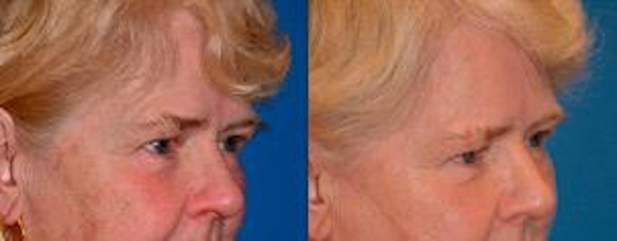 Skin Resurfacing Before & After Gallery - Patient 122406798 - Image 2