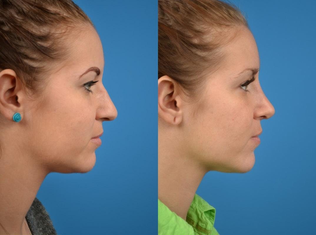 Rhinoplasty Before & After Gallery - Patient 122406799 - Image 2