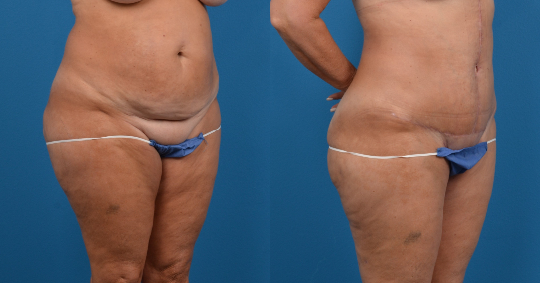Hidden Tummy Tuck Before & After Gallery - Patient 725304 - Image 3