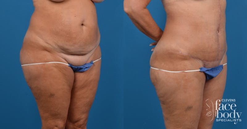 Hidden Tummy Tuck Before & After Gallery - Patient 725304 - Image 3