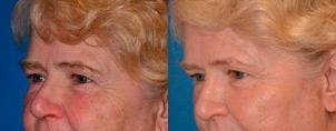 Skin Resurfacing Before & After Gallery - Patient 122406798 - Image 3
