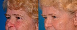 Skin Resurfacing Before & After Gallery - Patient 122406798 - Image 3