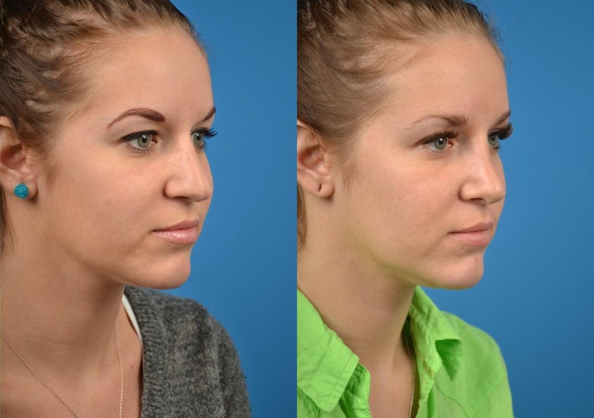 Rhinoplasty Before & After Gallery - Patient 122406799 - Image 3