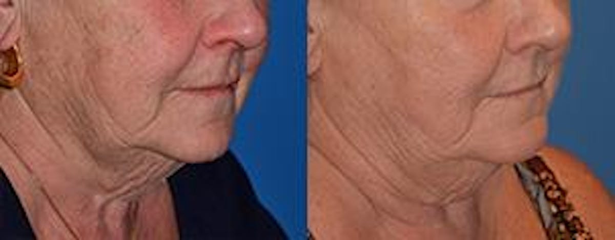Skin Resurfacing Before & After Gallery - Patient 122406798 - Image 4
