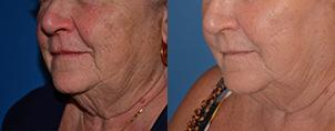 Skin Resurfacing Before & After Gallery - Patient 122406798 - Image 5