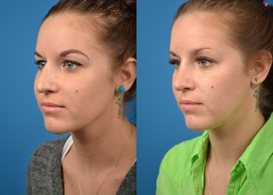 Rhinoplasty Before & After Gallery - Patient 122406799 - Image 4