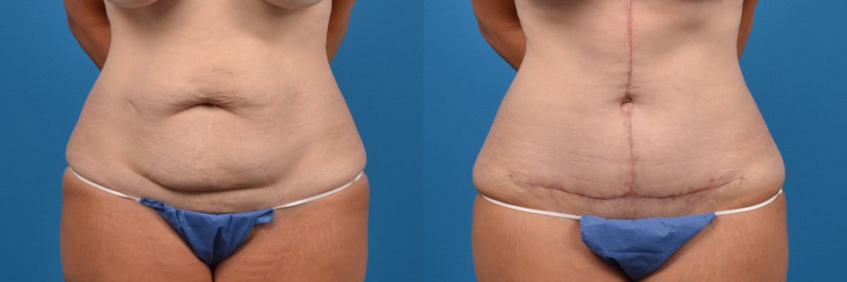 Tummy Tuck Before & After Gallery - Patient 118883 - Image 1