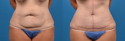 Tummy Tuck Before & After Gallery - Patient 118883 - Image 1