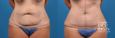 Hidden Tummy Tuck Before & After Gallery - Patient 370221 - Image 1