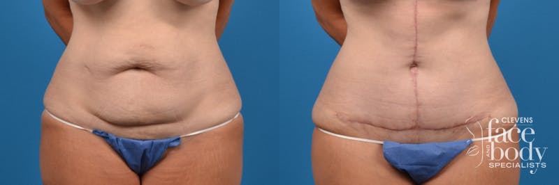 Hidden Tummy Tuck Before & After Gallery - Patient 370221 - Image 1