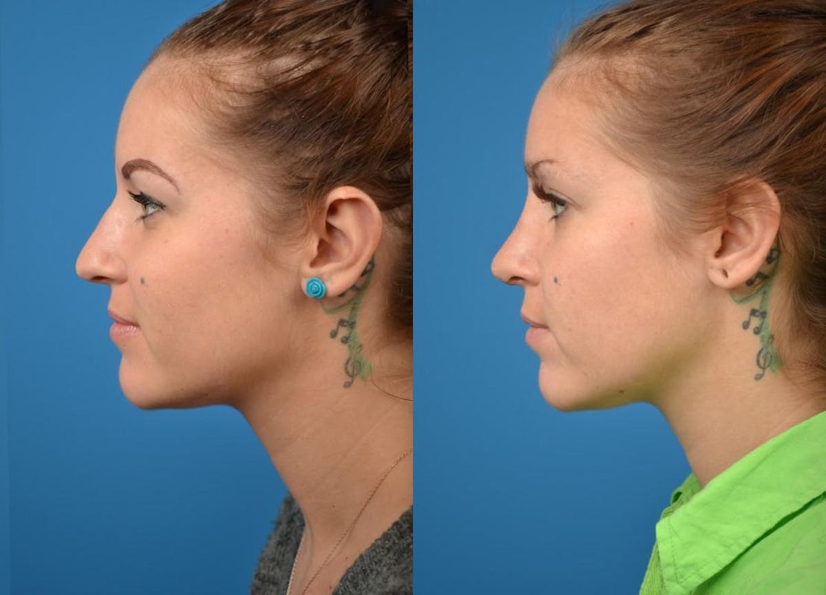 Rhinoplasty Before & After Gallery - Patient 122406799 - Image 5