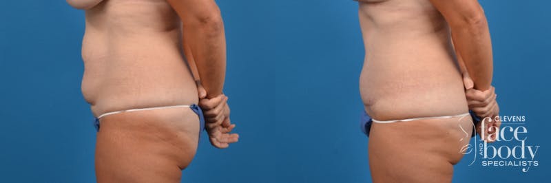 Hidden Tummy Tuck Before & After Gallery - Patient 370221 - Image 2
