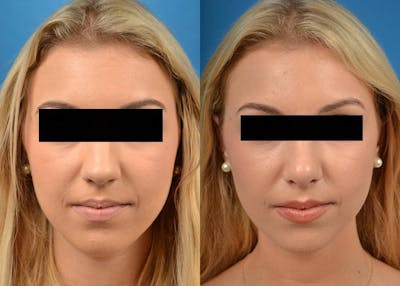 Rhinoplasty Before & After Gallery - Patient 122406803 - Image 1