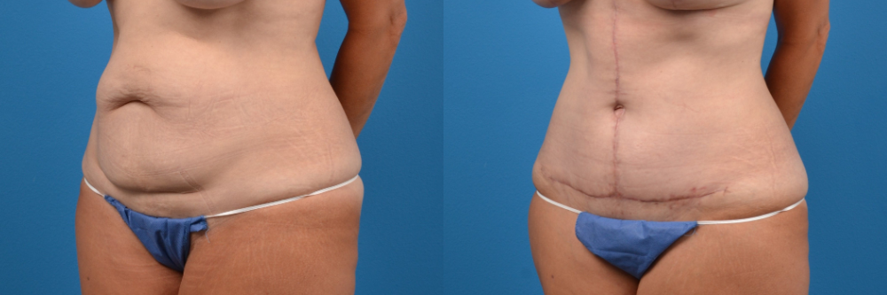Hidden Tummy Tuck Before & After Gallery - Patient 370221 - Image 3