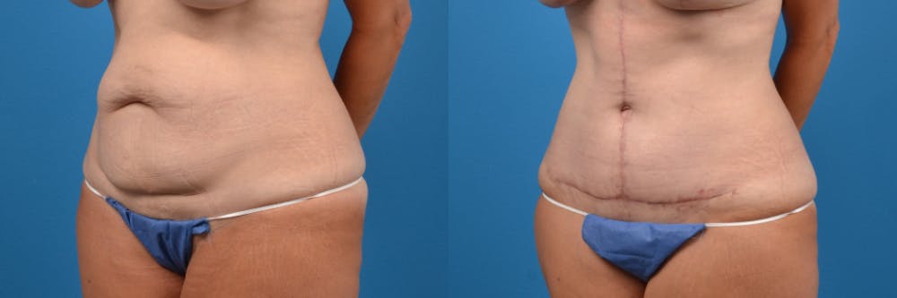 Tummy Tuck Before & After Gallery - Patient 122406800 - Image 3