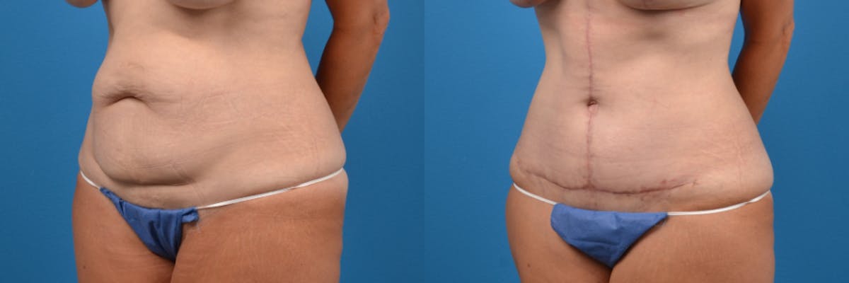 Tummy Tuck Before & After Gallery - Patient 118883 - Image 3