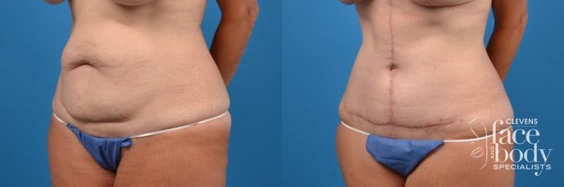 Hidden Tummy Tuck Before & After Gallery - Patient 370221 - Image 3