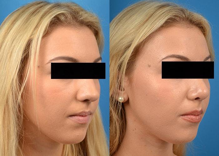 Rhinoplasty Before & After Gallery - Patient 122406803 - Image 2