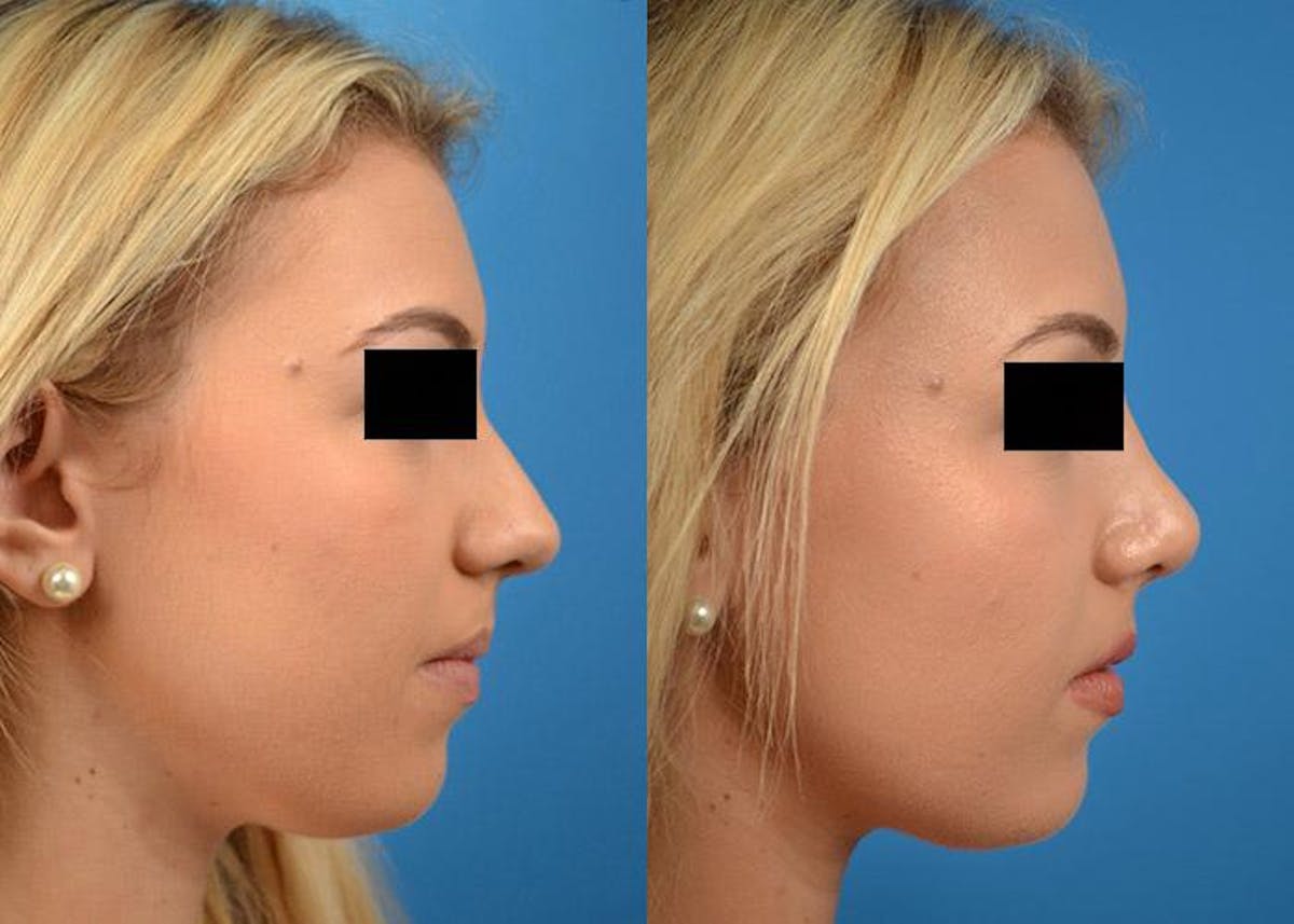 Rhinoplasty Before & After Gallery - Patient 122406803 - Image 3
