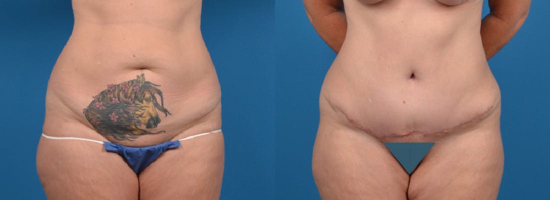 Tummy Tuck Before & After Gallery - Patient 122406802 - Image 1