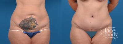 Hidden Tummy Tuck Before & After Gallery - Patient 260179 - Image 1