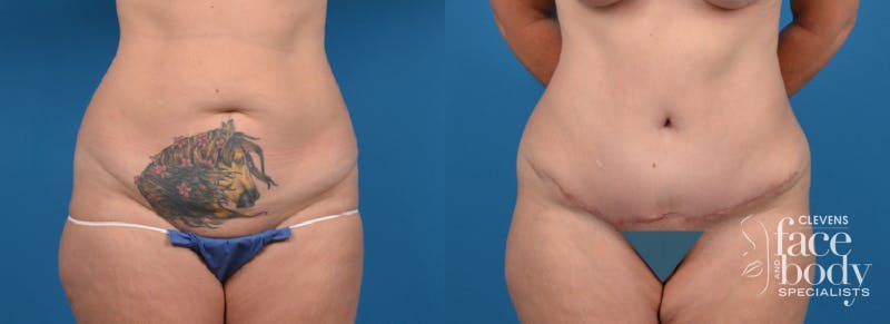 Hidden Tummy Tuck Before & After Gallery - Patient 260179 - Image 1