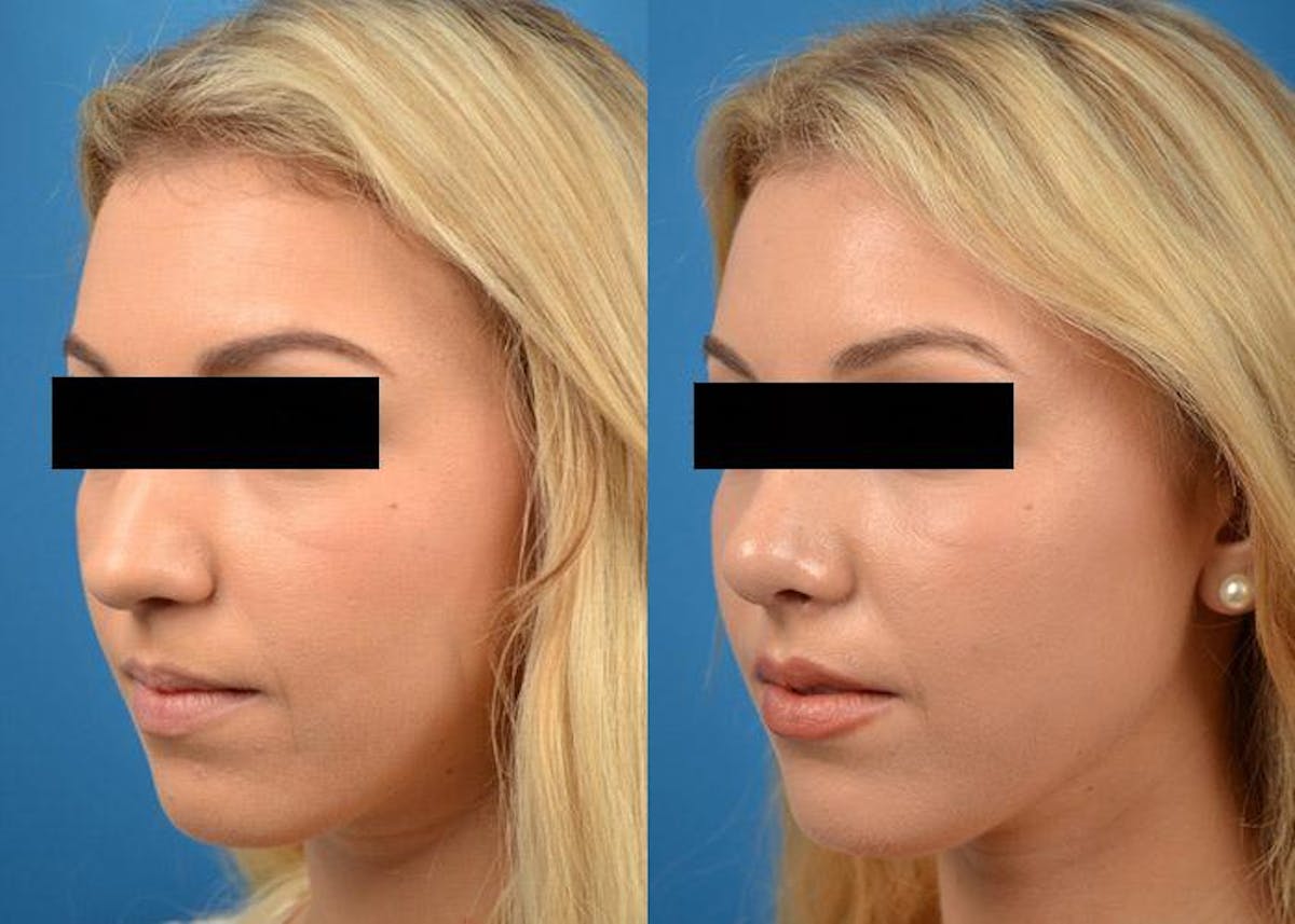 Rhinoplasty Before & After Gallery - Patient 122406803 - Image 4