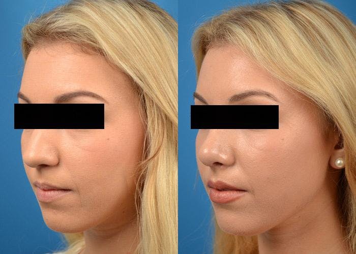 Rhinoplasty Before & After Gallery - Patient 122406803 - Image 4