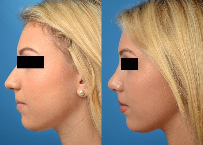 Rhinoplasty Before & After Gallery - Patient 122406803 - Image 5