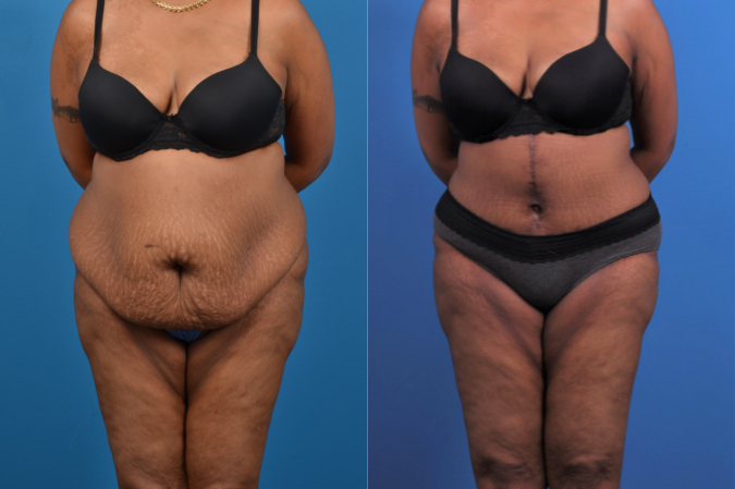 Hidden Tummy Tuck Before & After Gallery - Patient 426322 - Image 1