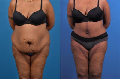 Tummy Tuck Before & After Gallery - Patient 177063 - Image 1