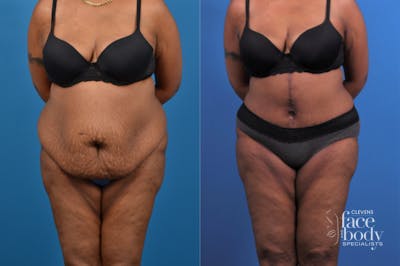 Hidden Tummy Tuck Before & After Gallery - Patient 426322 - Image 1
