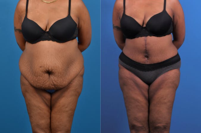 Tummy Tuck Before & After Gallery - Patient 122406804 - Image 1