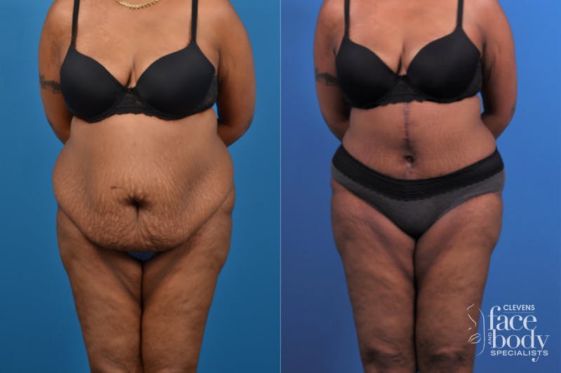 Hidden Tummy Tuck Before & After Gallery - Patient 426322 - Image 1