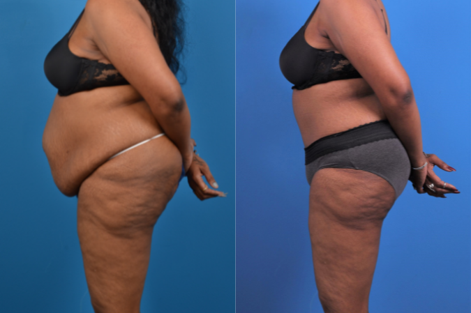 Hidden Tummy Tuck Before & After Gallery - Patient 426322 - Image 2