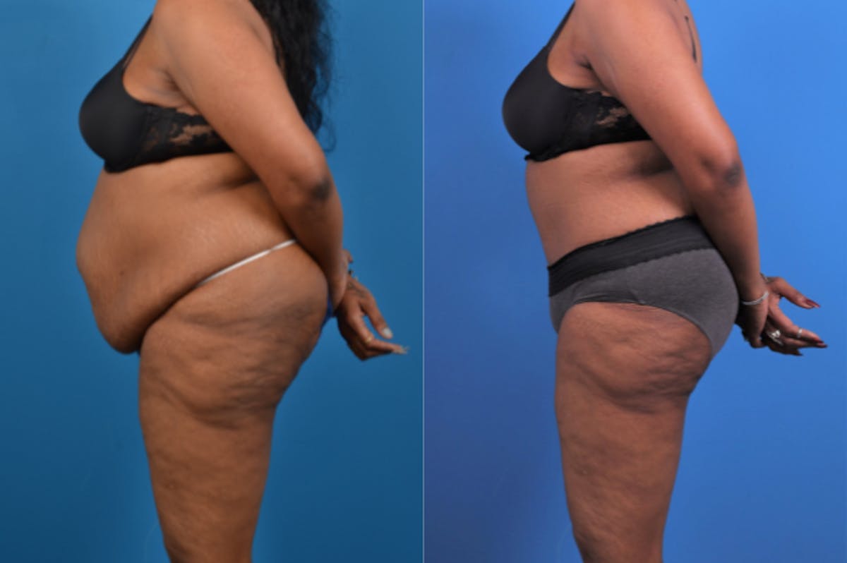 Tummy Tuck Before & After Gallery - Patient 177063 - Image 2