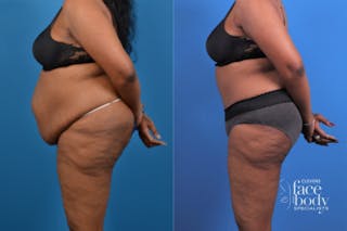 Hidden Tummy Tuck Before & After Gallery - Patient 426322 - Image 2