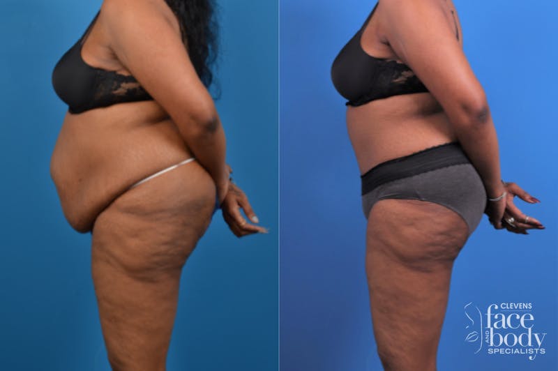 Hidden Tummy Tuck Before & After Gallery - Patient 426322 - Image 2