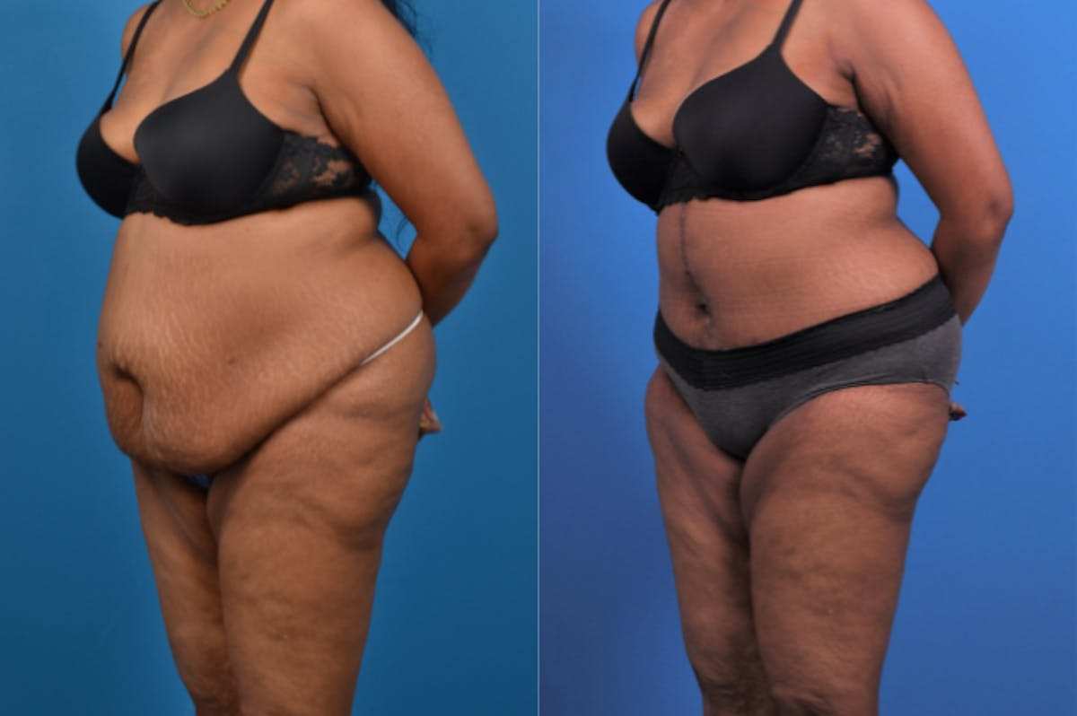 Hidden Tummy Tuck Before & After Gallery - Patient 426322 - Image 3