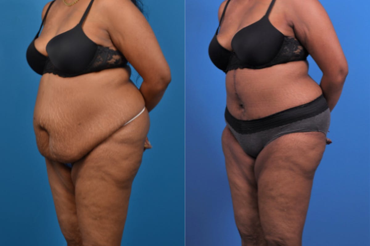 Tummy Tuck Before & After Gallery - Patient 177063 - Image 3